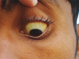 Белки глаз человека, пораженного гепатитом Е