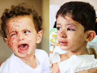 Среди погибших и раненых в результате израильских бомбардировок много детей