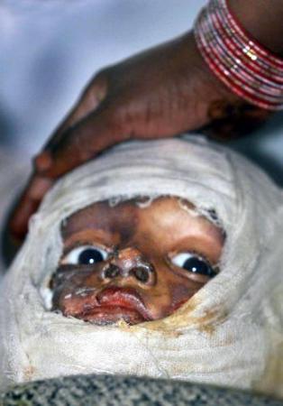 Обгоревший мусульманский ребенок, один из тысяч пострадавших в  2002 году в Гуджарате