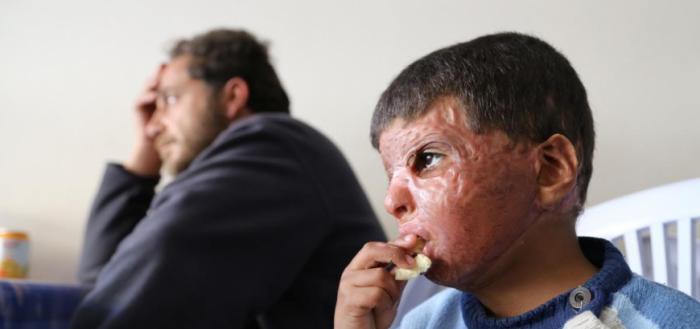 Лицо пятилетнего мальчика Мустафы Баккура было полностью сожжено в результате взрыва бочковой бомбы, сброшенной правительственным вертолетом на жилой дом