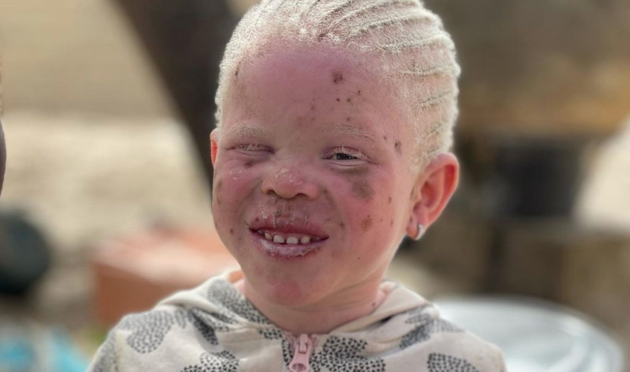 Фото африканского ребенка-альбиноса  - С. Романович